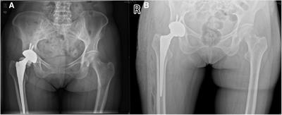 Ceramic fragmentation after total hip arthroplasty: two case reports and literature review
